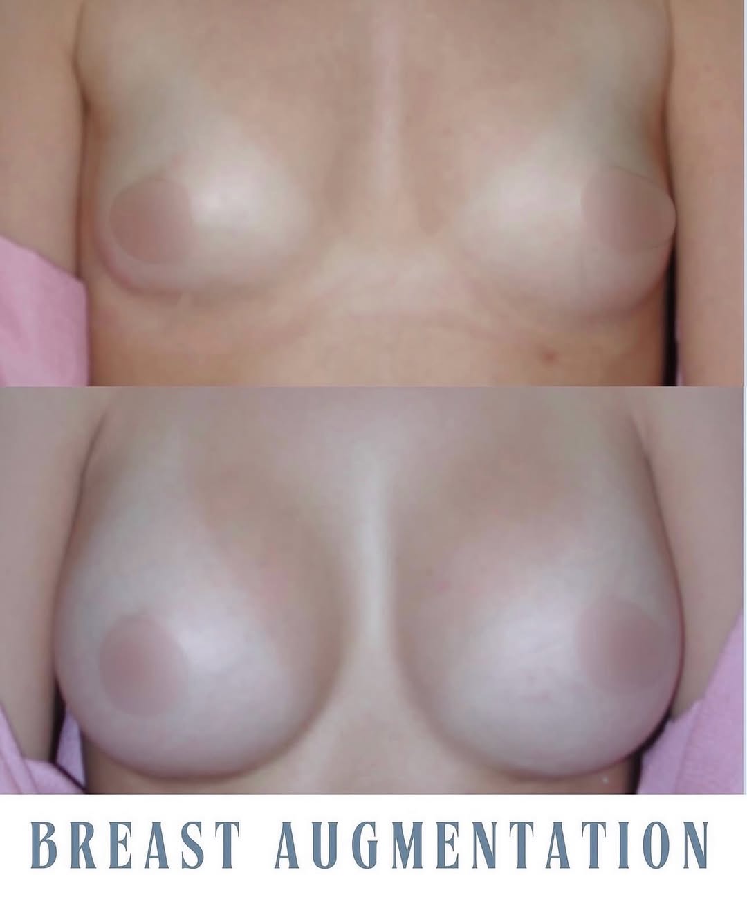 Instagram post by Dr. Robert E. Rothfield: A stunning breast augmentation transformation! ✨ These results are simply beautiful, giving her a renewed sense of confidence and comfort in…