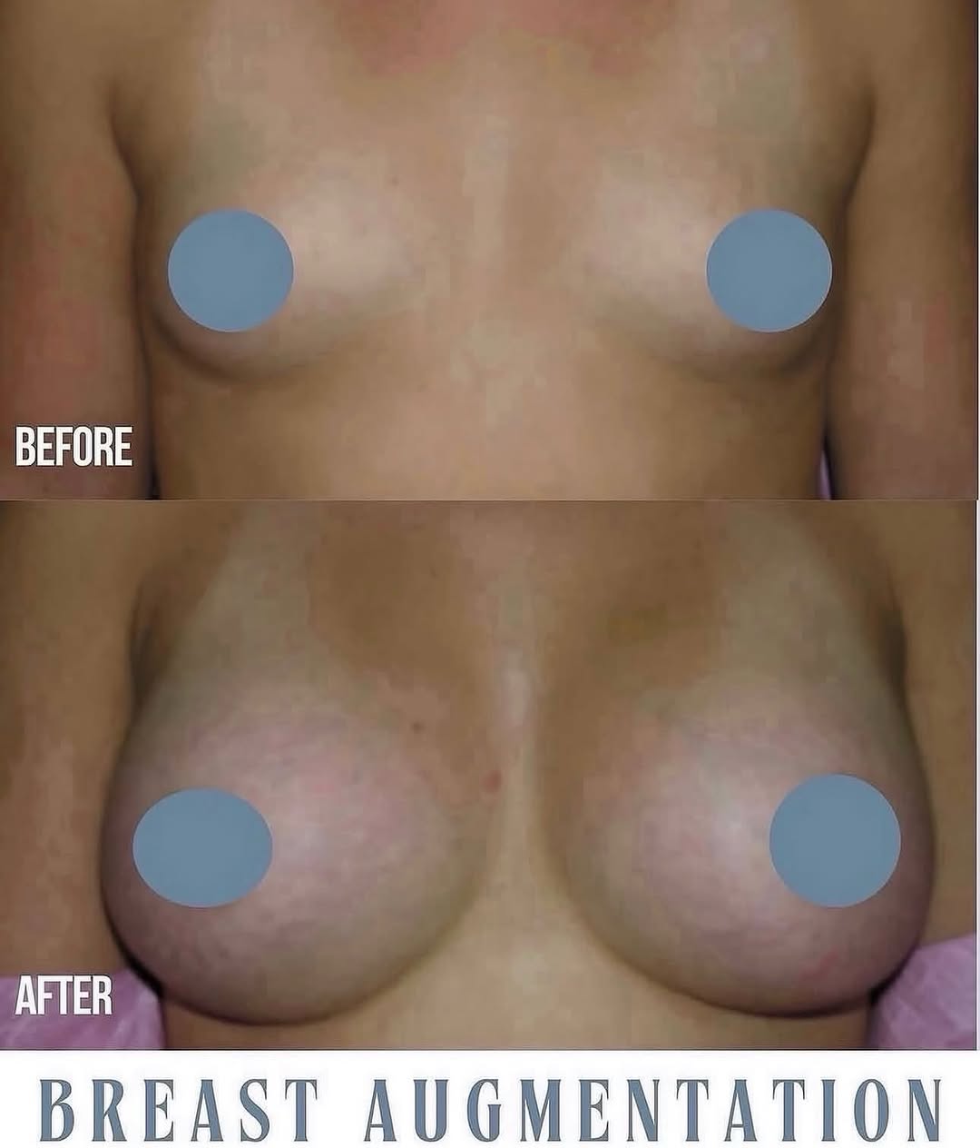 Instagram post by Dr. Robert E. Rothfield: ✨ Stunning breast augmentation results ✨ This beautiful transformation highlights natural balance, enhanced shape, and renewed confidence. H…