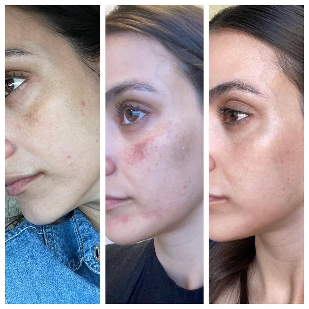 Skin transformation before and after Sciton bbl laser treatment. Hyperpigmentation treatment.