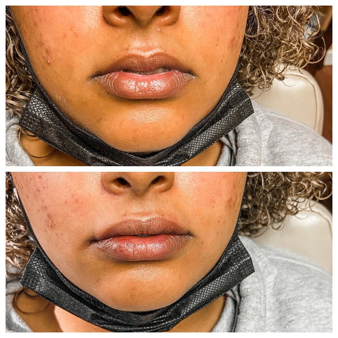 Lip filler, restylane kysse, nurse injector