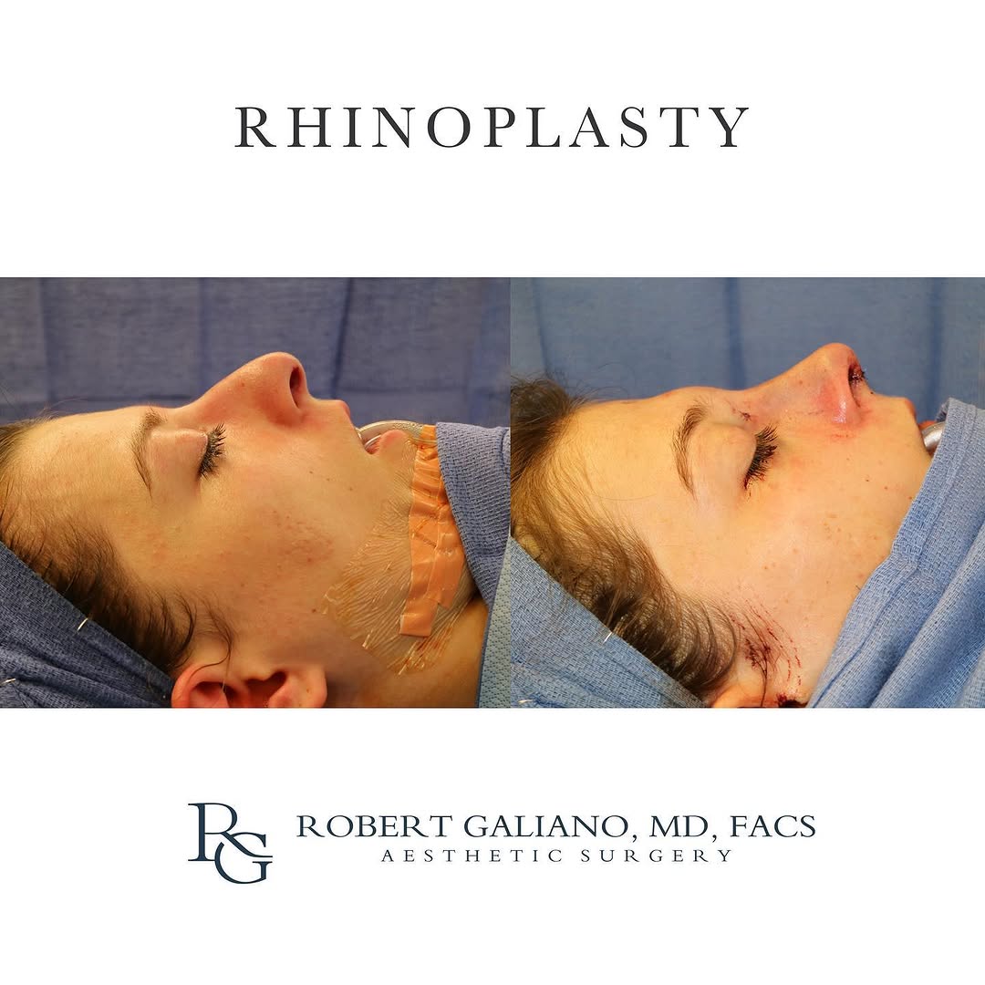 Instagram post by Dr. Robert Galiano: This lovely young lady underwent a comprehensive septorhinoplasty. She had a complex deviation of her septum, and this not only made it diff…