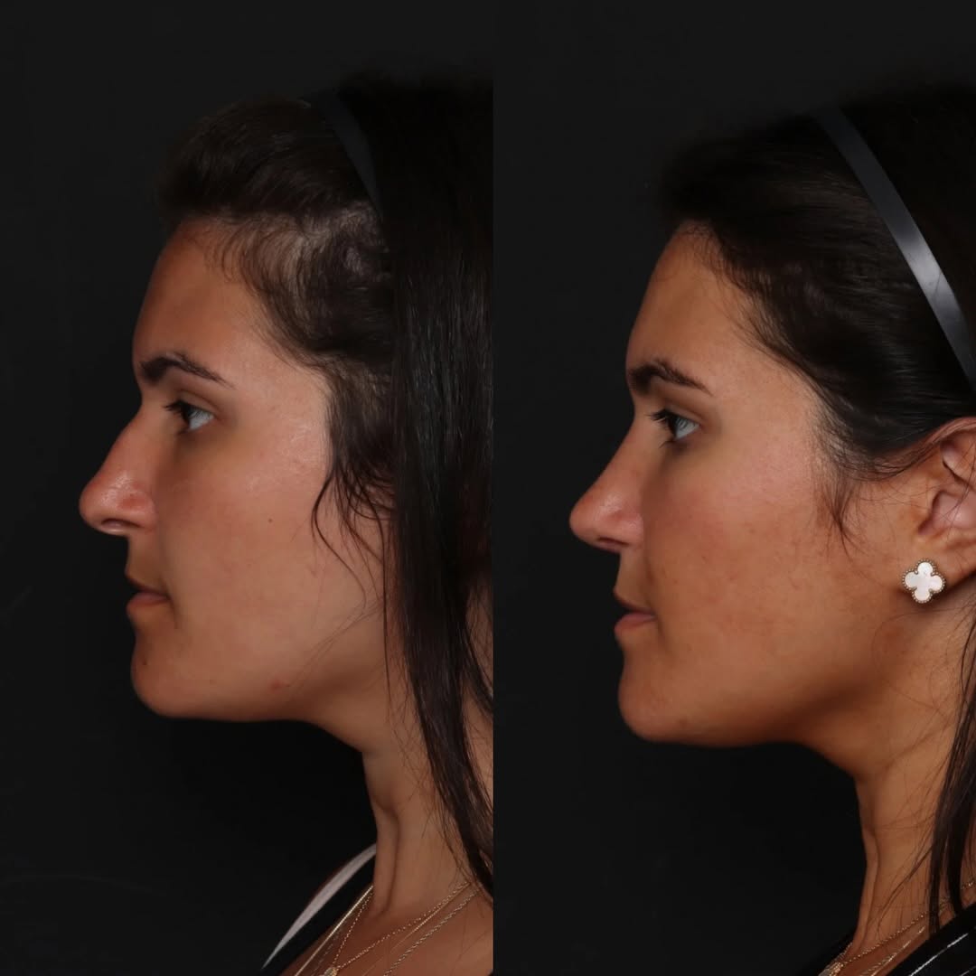 Instagram post by Dr. Robert Glasgold: Rhinoplasty -5 Months Post Op: Our lovely patient is shown here 5 months out from a rhinoplasty. The bridge has been refined and the tip sub…