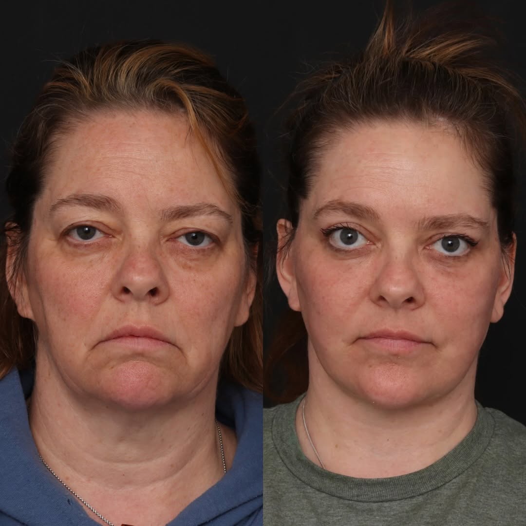 Instagram post by Dr. Robert Glasgold: Starting the morning off with this amazing transformation. Our wonderful patient is shown here just 3 months after her deep plane face and n…