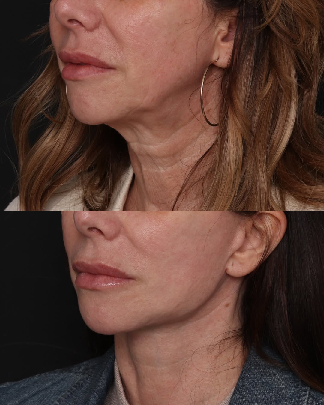 Instagram post by Dr. Robert Glasgold: Deep Plane Face & Neck Lift Coming up on the 2 year mark. This stunning transformation showcases the lasting power of a deep plane face and …
