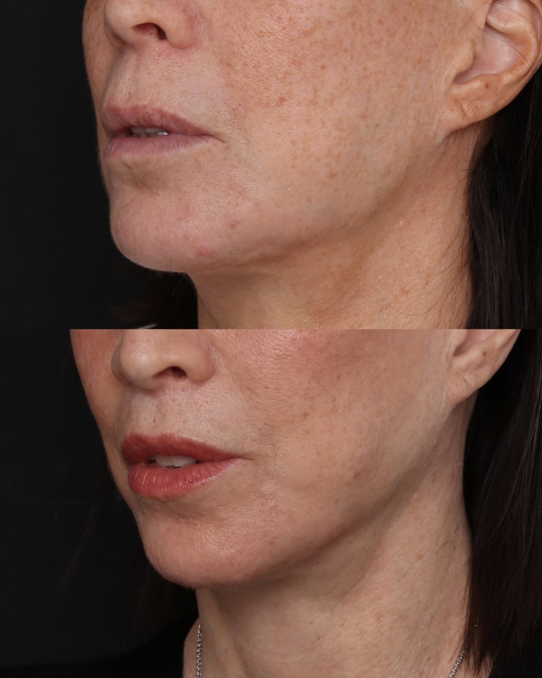 Instagram post by Dr. Robert Glasgold: 👄 Lip Lift - 9 months Post Op: As we age, the philtrum — the space between the nose and upper lip — naturally lengthens, often contributing…