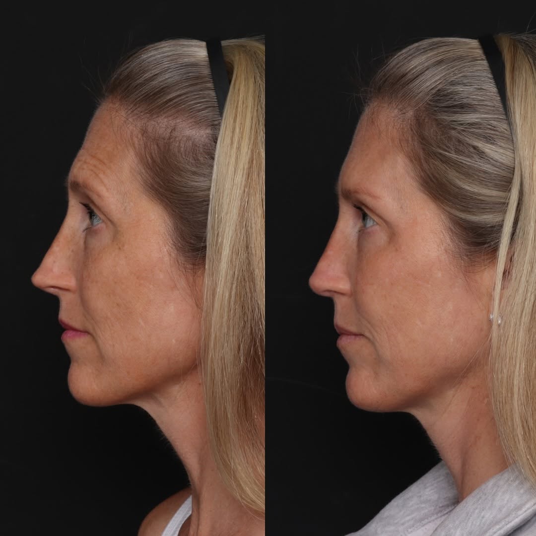 Instagram post by Dr. Robert Glasgold: Revision Rhinoplasty • 10 Months Post-Op This patient’s revision procedure focused on improving contour irregularities and refining the tip.…