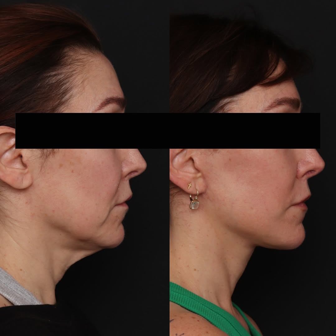 Instagram post by Dr. Robert Glasgold: Deep Plane Face & Neck Lift • 6 months Post Op: Our lovely patient is shown here, 6 months post op, showing improved lower facial support, j…