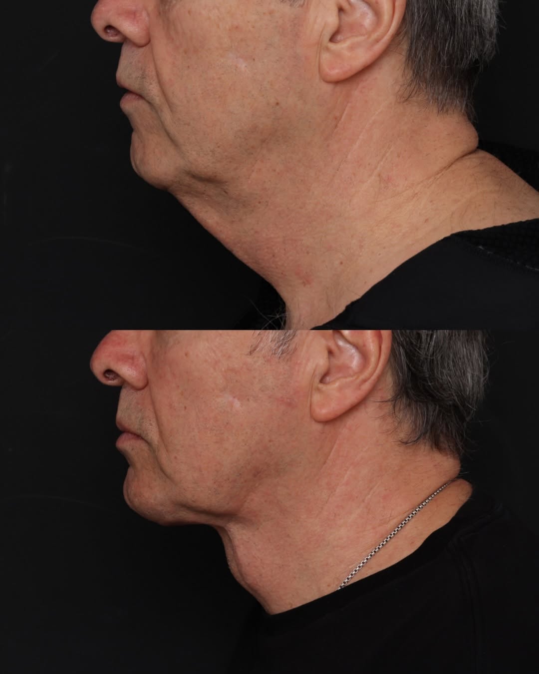 Instagram post by Dr. Robert Glasgold: Neck Lift: 1.5 years Post-Op This long-term result shows beautiful improvement in the definition of the jawline and neck, creating a smoothe…