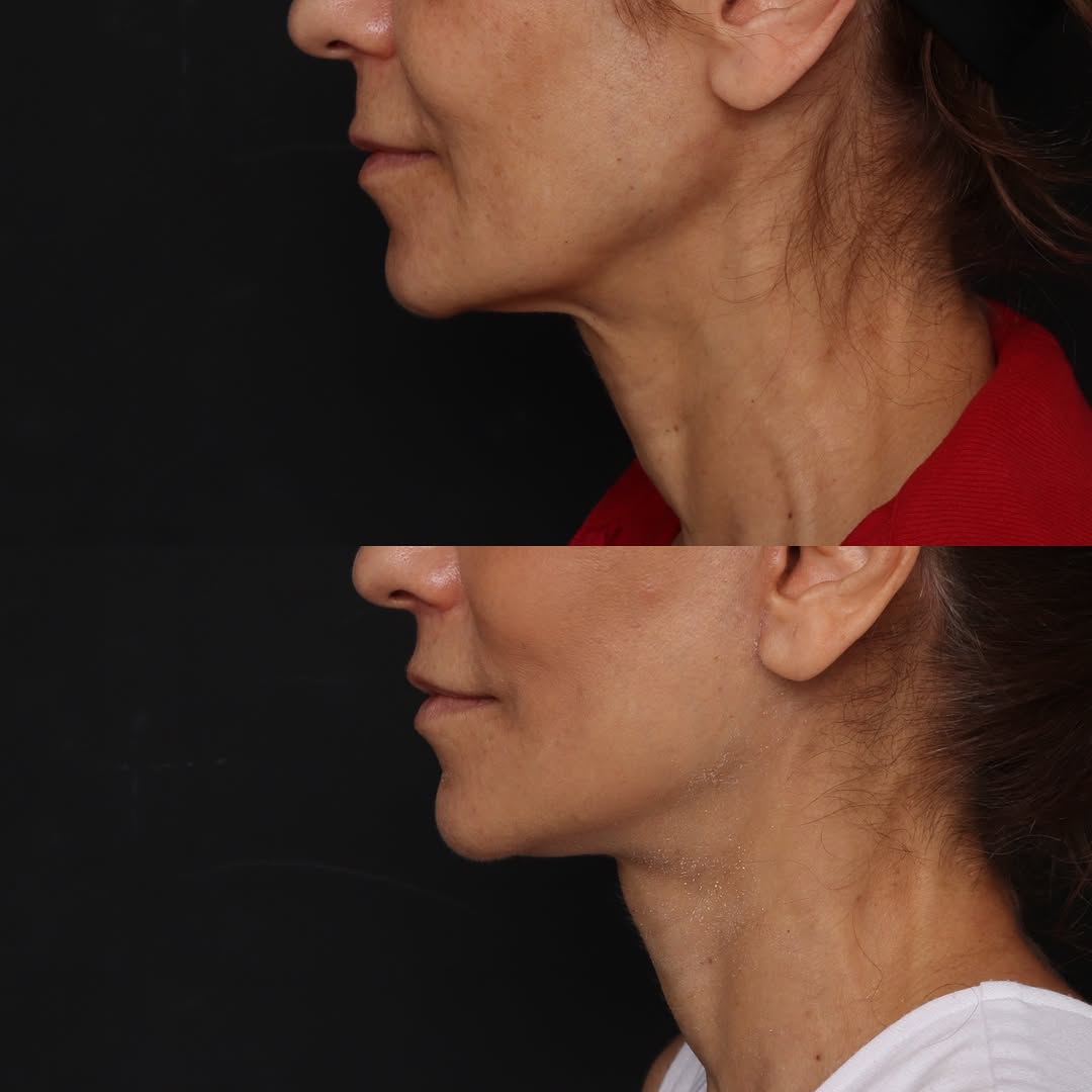 Instagram post by Dr. Robert Glasgold: Deep-plane facelift and upper lip lift: 4 months postop Our wonderful patient demonstrates dramatic yet natural changes. With her jowls and …