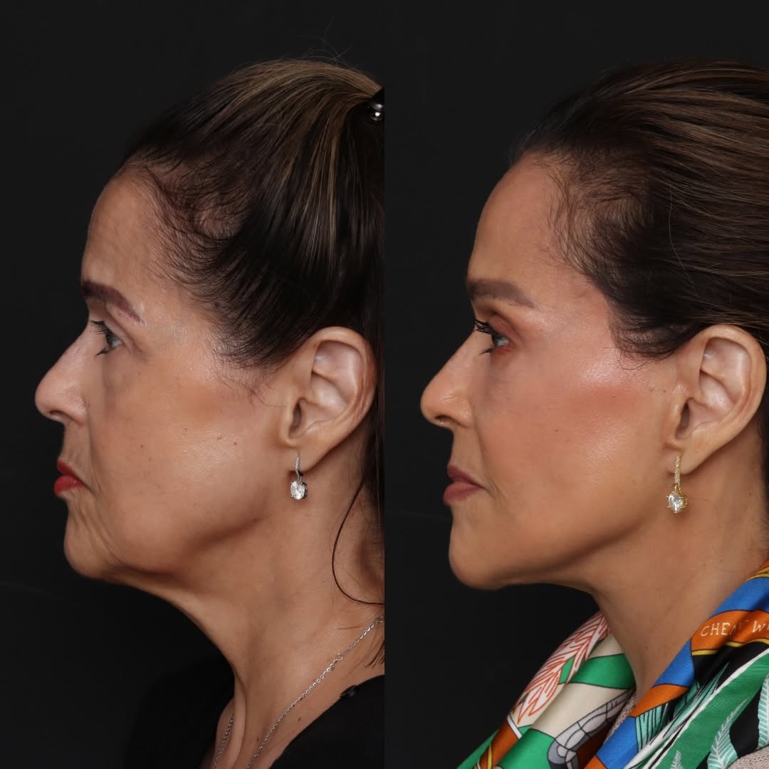 Instagram post by Dr. Robert Glasgold: Deep Plane Face & Neck Lift Lower Blepharoplasty with Fat Transfer 1 year post-op Our lovely patient underwent a deep plane face & neck lift…