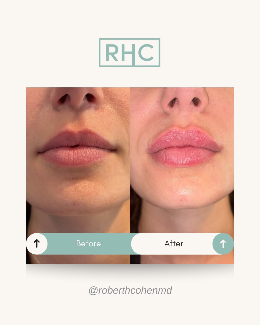Instagram post by Dr. Robert H. Cohen: Before and after lip filler 💉 Most hyaluronic acid lip fillers typically last around 6–12 months. Who’s a good candidate? Someone looking t…