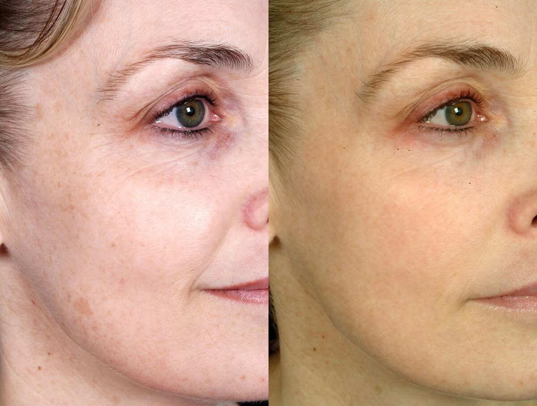 Instagram post by Dr. Robert Haber: Tired skin? Meet Affirm® Laser. This FDA-cleared laser treatment smooths fine lines, evens out texture, fades sun damage and acne scars, and…