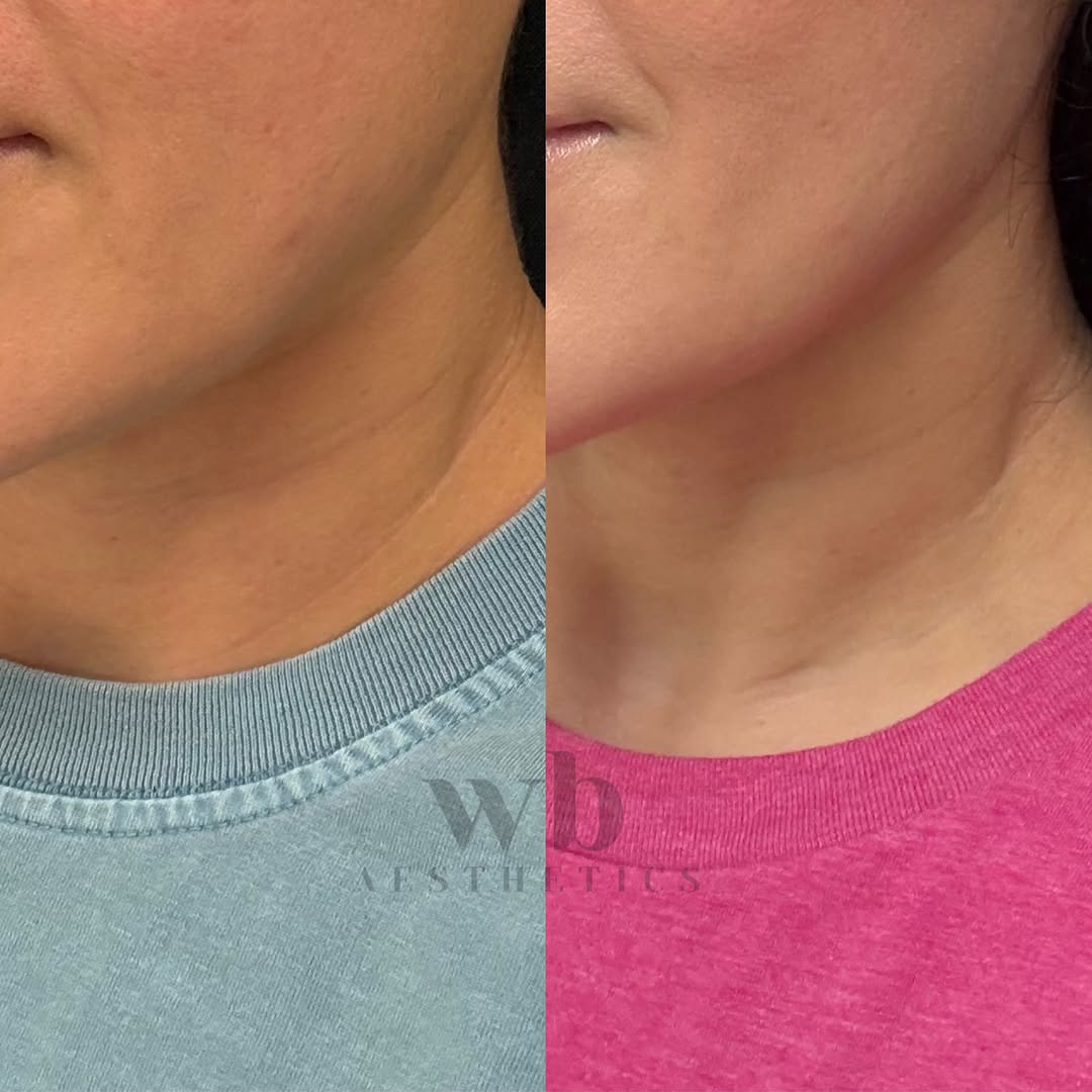 Instagram post by Dr. Robert Hein: ✨M I C R O N E E D L I N G✨ A personal review of SkinPen and what it can do overall, but especially what it can do in the neck. Life changin…