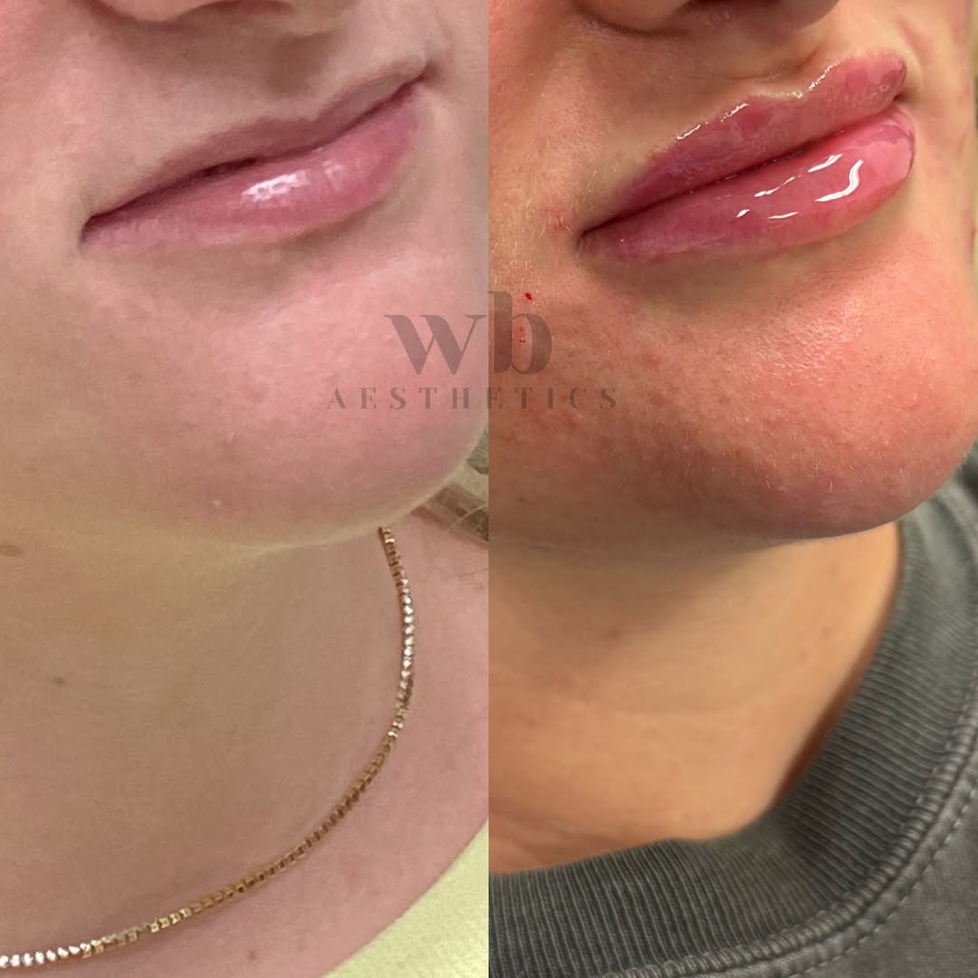 Instagram post by Dr. Robert Hein: L I P S ✨ A natural result for a natural beauty! This particular result was achieved over approximately 18 months/4 sessions using small amo…