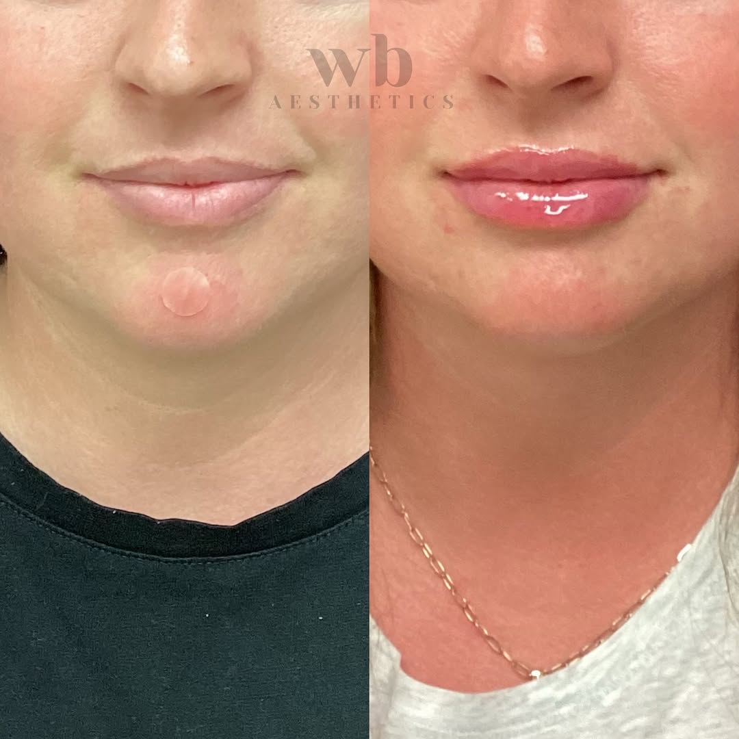 Instagram post by Dr. Robert Hein: L I P S ✨ Busy szn lippies 😍 . . . . . . 🌎 Stillwater 📧 wbaesthetics405@gmail.com ☎️ 405-500-2121 📸 All images have been obtained and sh…
