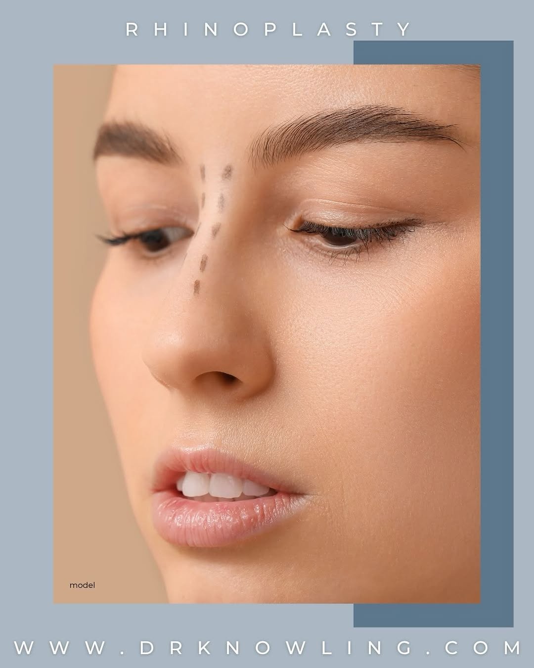 Instagram post by Dr. Robert J. Knowling: Rhinoplasty is a highly customizable procedure that can address cosmetic concerns such as bumps or humps on the nose, a bulbous or too-large…