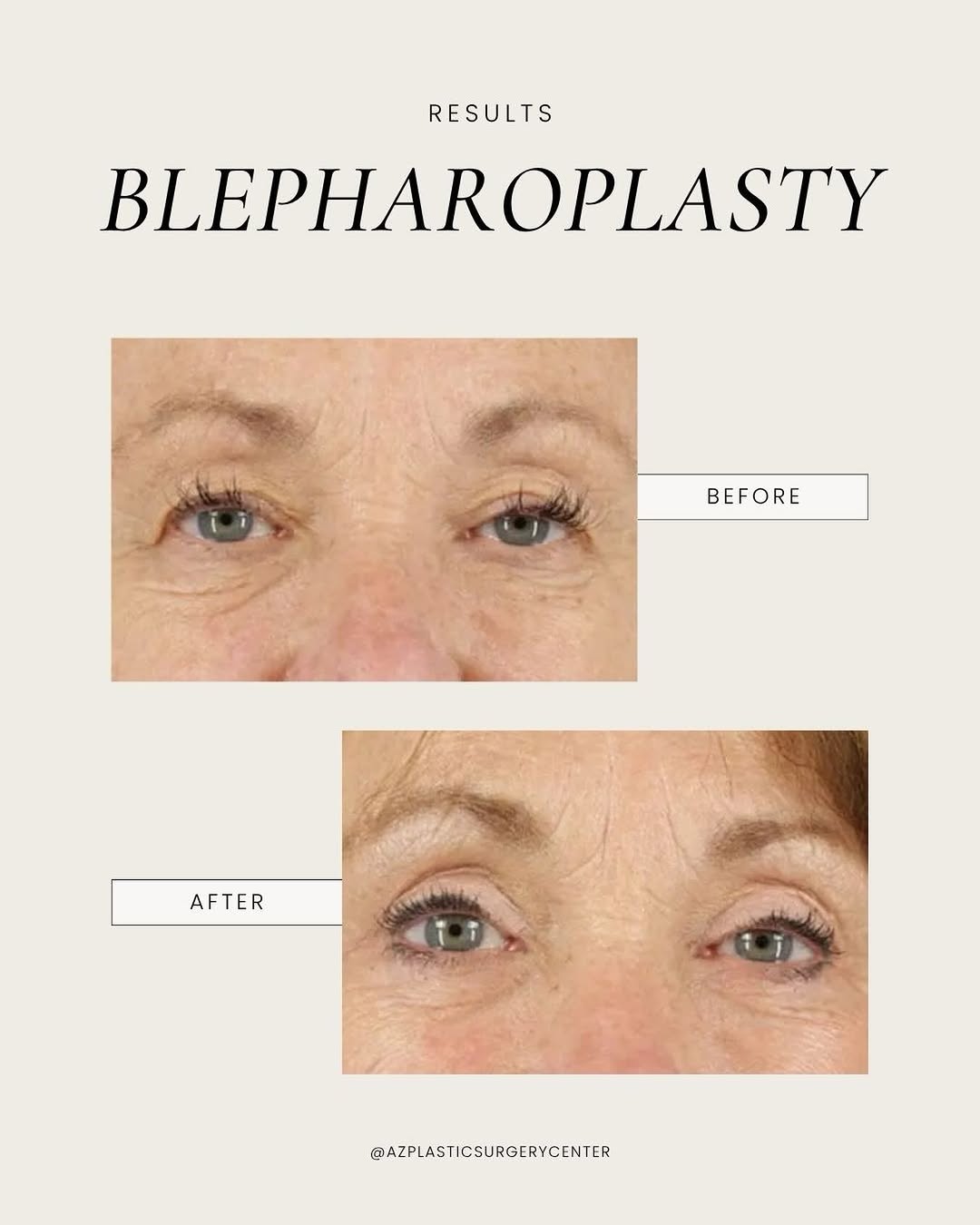 Instagram post by Dr. Robert J. Spies: If you always look tired even when you’re well rested, you’re not alone. ⠀ This 59 year old patient came to Dr. Spies with that exact concer…