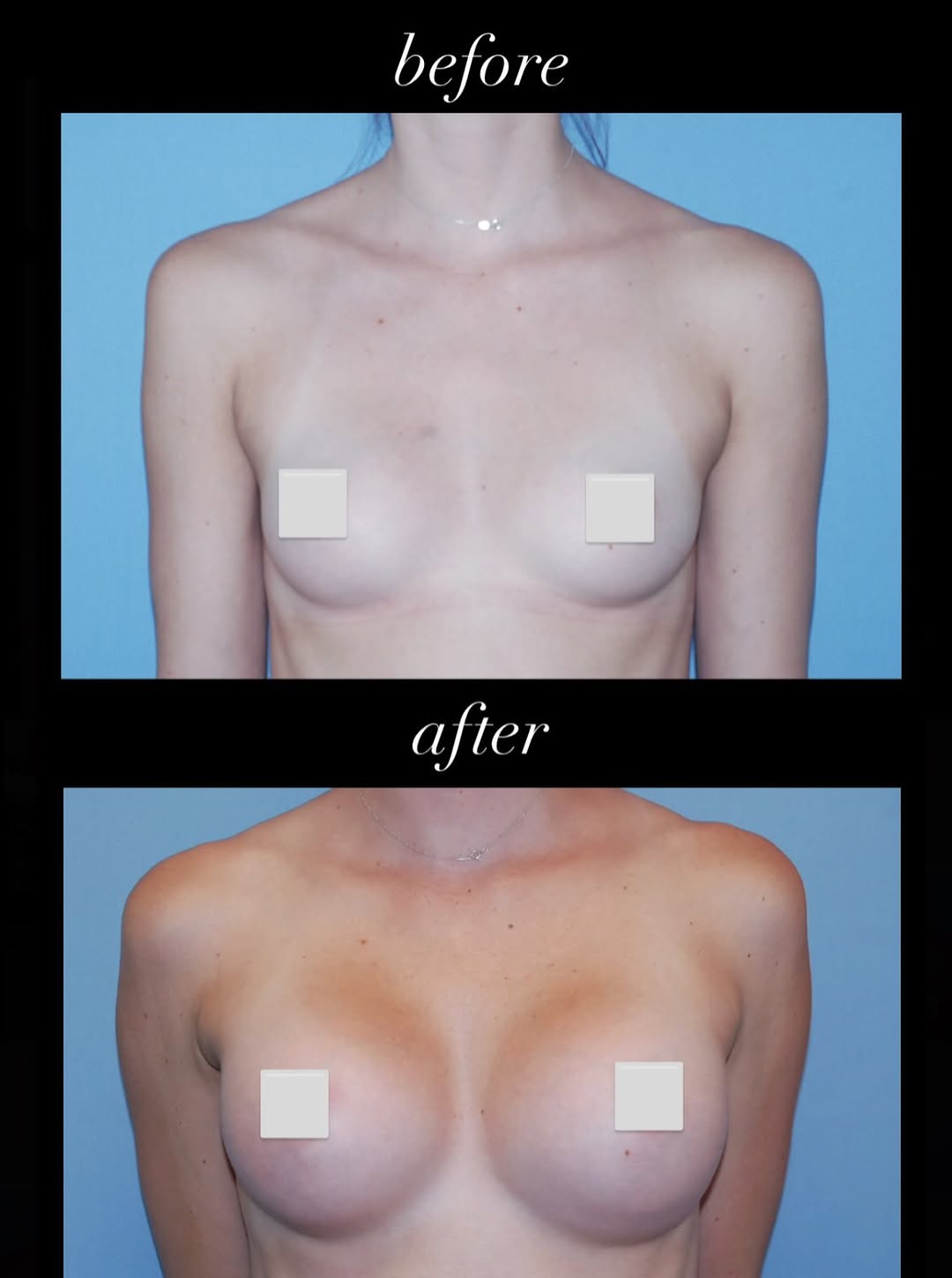 Instagram post by Dr. Robert Kearney: Stunning results with a transaxillary incision - no scar on the breasts! #transax #implants