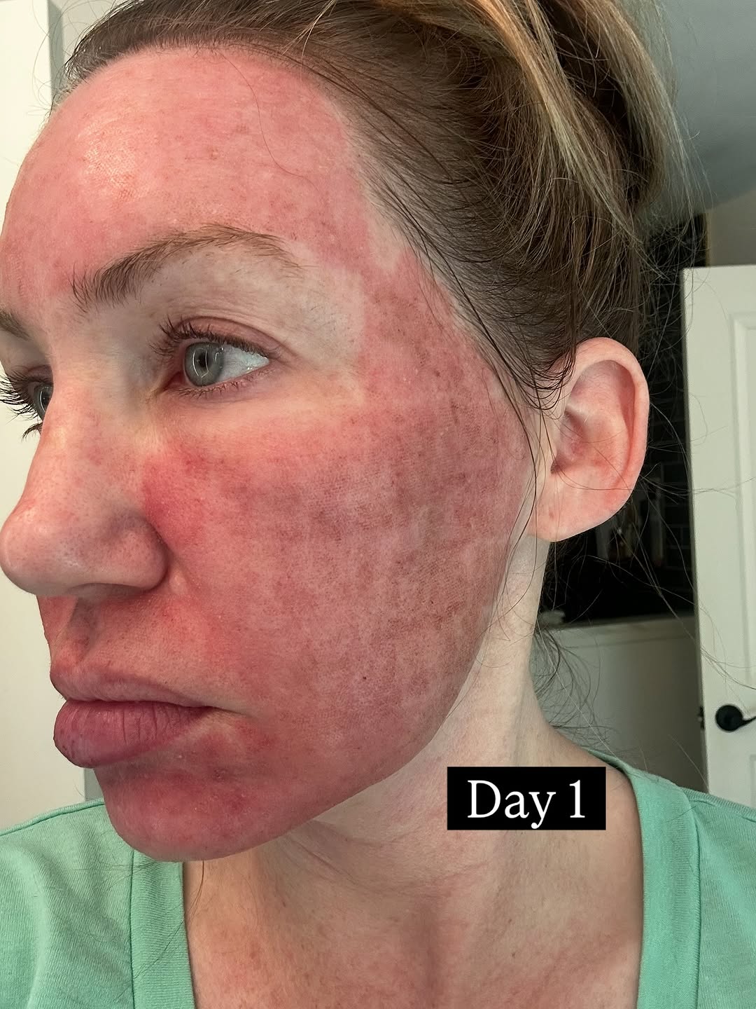 Instagram post by Dr. Robert Kratschmer: Correct and tighten your skin with CO2 laser ✨ This advanced laser treatment can improve both skin texture and tone while stimulating deep c…