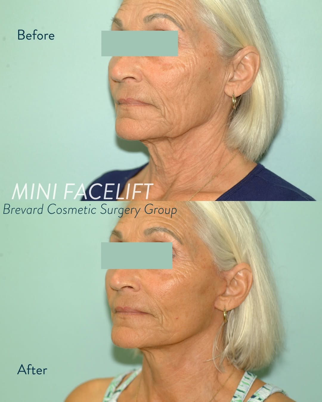 Instagram post by Dr. Robert L. Bashore: One of the biggest misconceptions about facelifts is that age determines which procedure is needed. A mini facelift vs. facelift is determin…