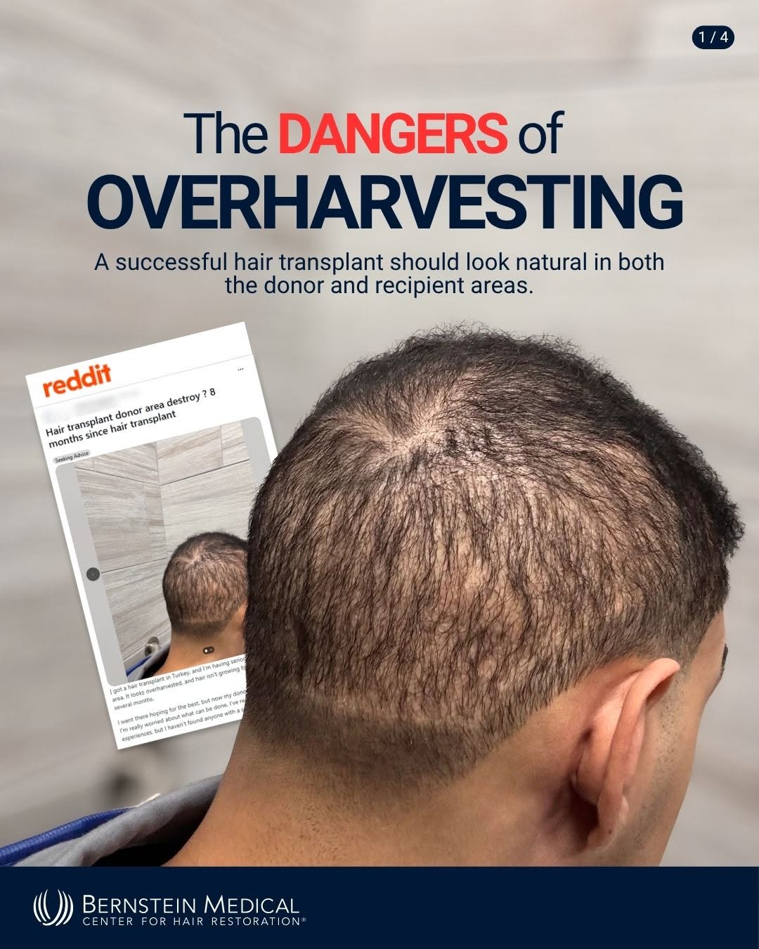 Instagram post by Dr. Robert M. Bernstein: More grafts do not automatically mean a better hair transplant. Your donor area is a limited resource because the follicles removed during F…
