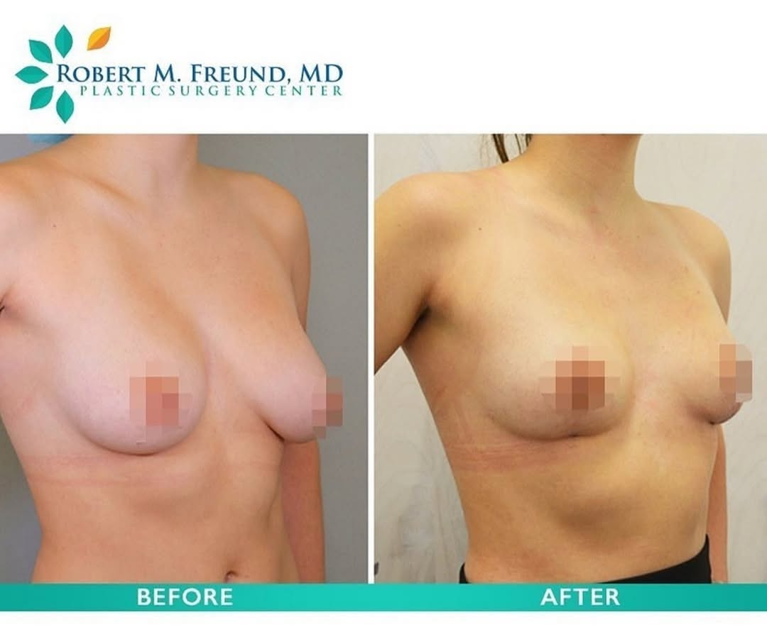 Instagram post by Dr. Robert M. Freund: In this before & after, our 23 year old patient was 5ft 4inch 125 pounds, a 34c cup with asymmetry, and wanted to be as small as possible bu…