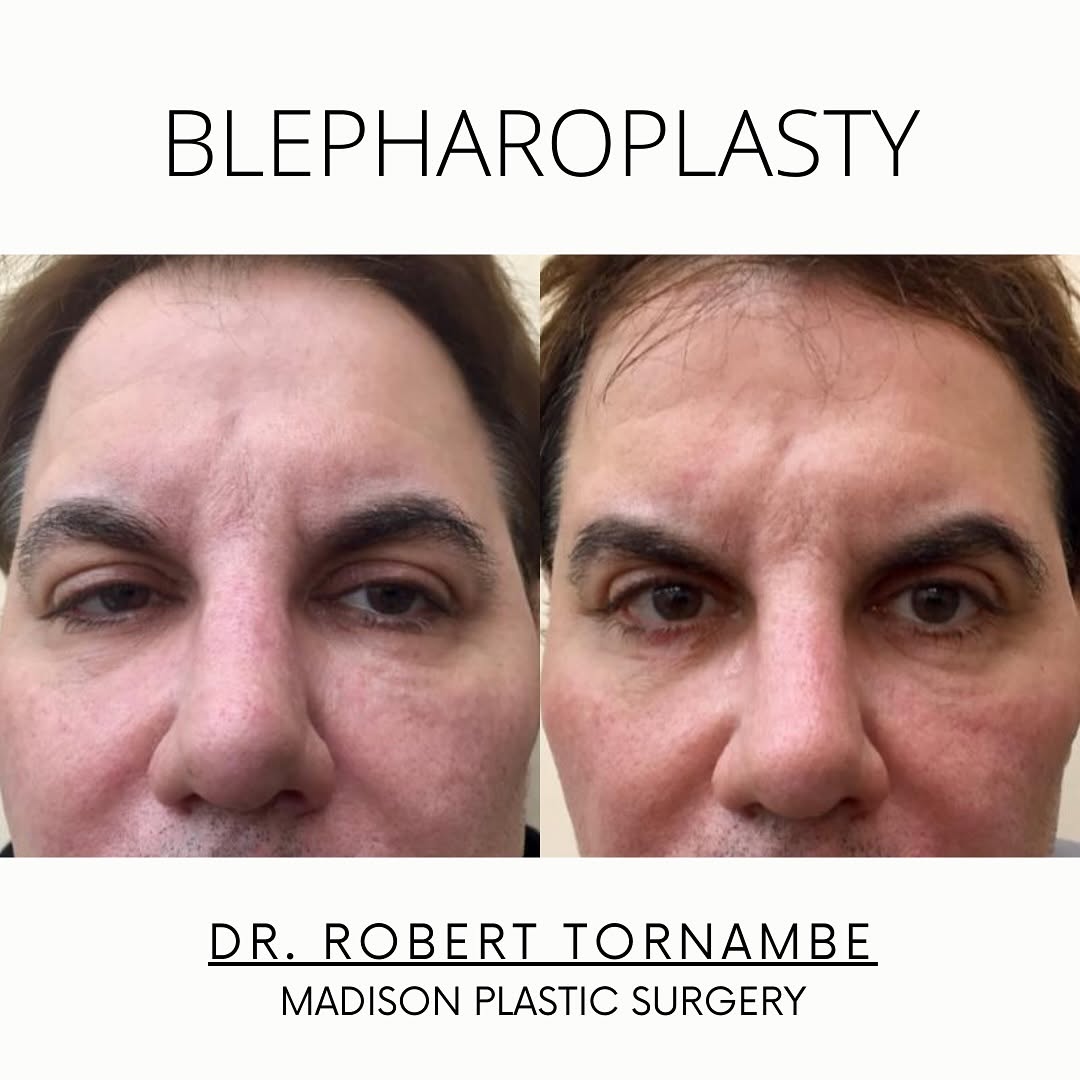 Instagram post by Dr. Robert M. Tornambe: A lower blepharoplasty is a procedure that addresses issues with the lower eyelids such as excess skin, bags, wrinkles, and puffiness. It is…