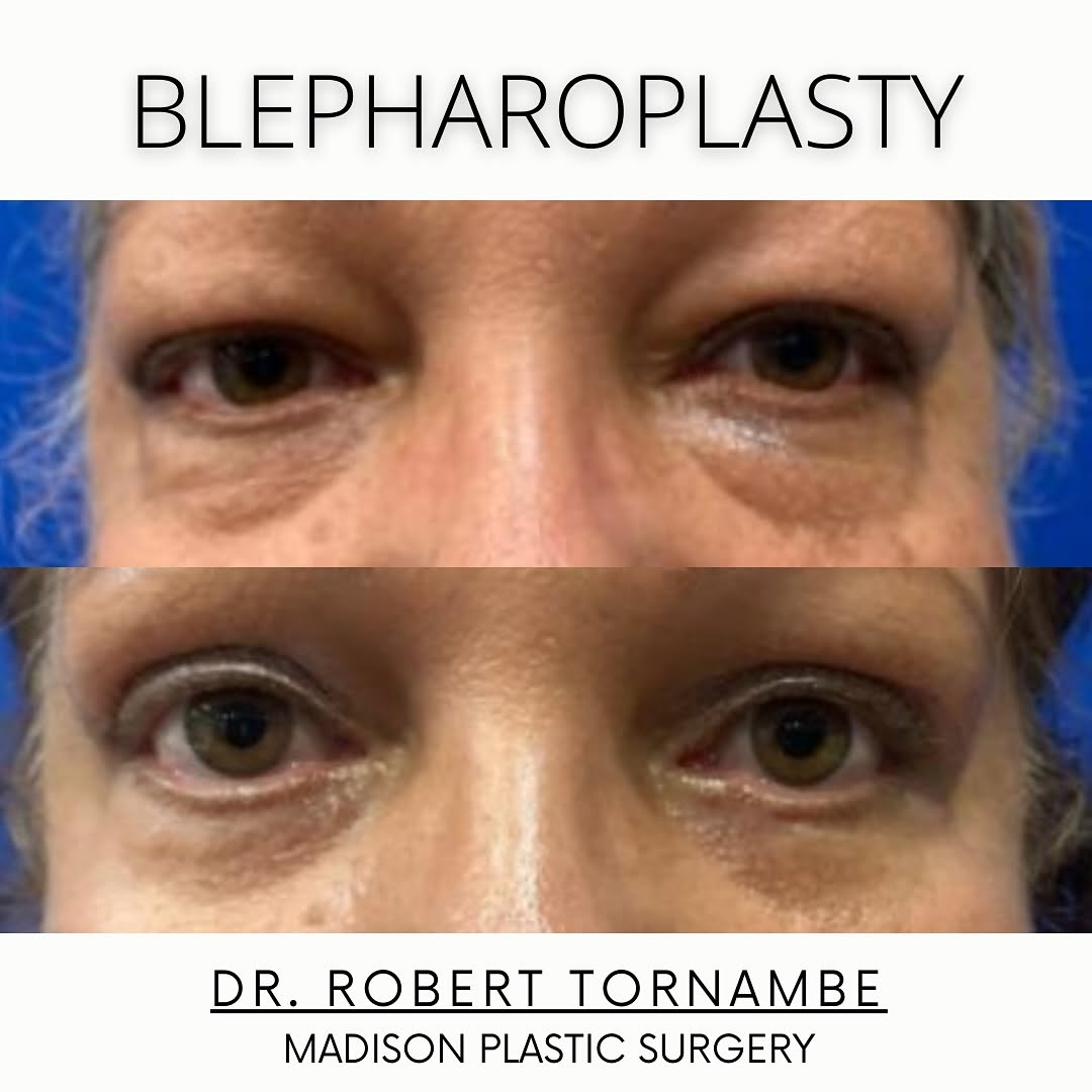 Instagram post by Dr. Robert M. Tornambe: A blepharoplasty may be beneficial if you have tired looking eyes, puffy eyelids, or excess skin around your eyes. The procedure removes the…