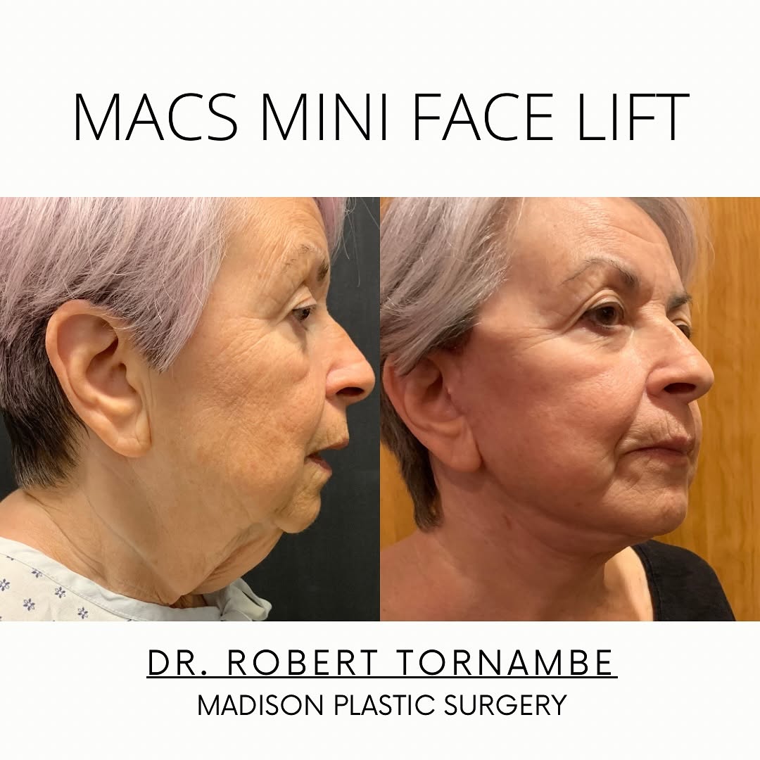 Instagram post by Dr. Robert M. Tornambe: MACS Mini Facelift for this Tuesday Transformation🤩 This procedure is the perfect solution to sagging skin on the lower portion of the face…