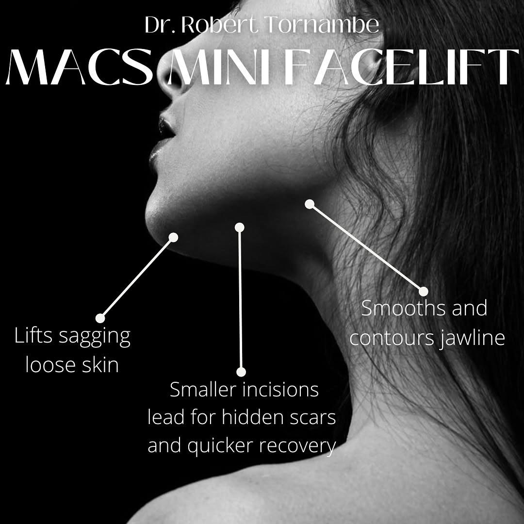 Instagram post by Dr. Robert M. Tornambe: Wondering if you’re a candidate for a MACS Mini Facelift? Candidate for the MACS Mini Facelift: ✔️ Sagging skin at the jowls ✔️ Loosening ne…