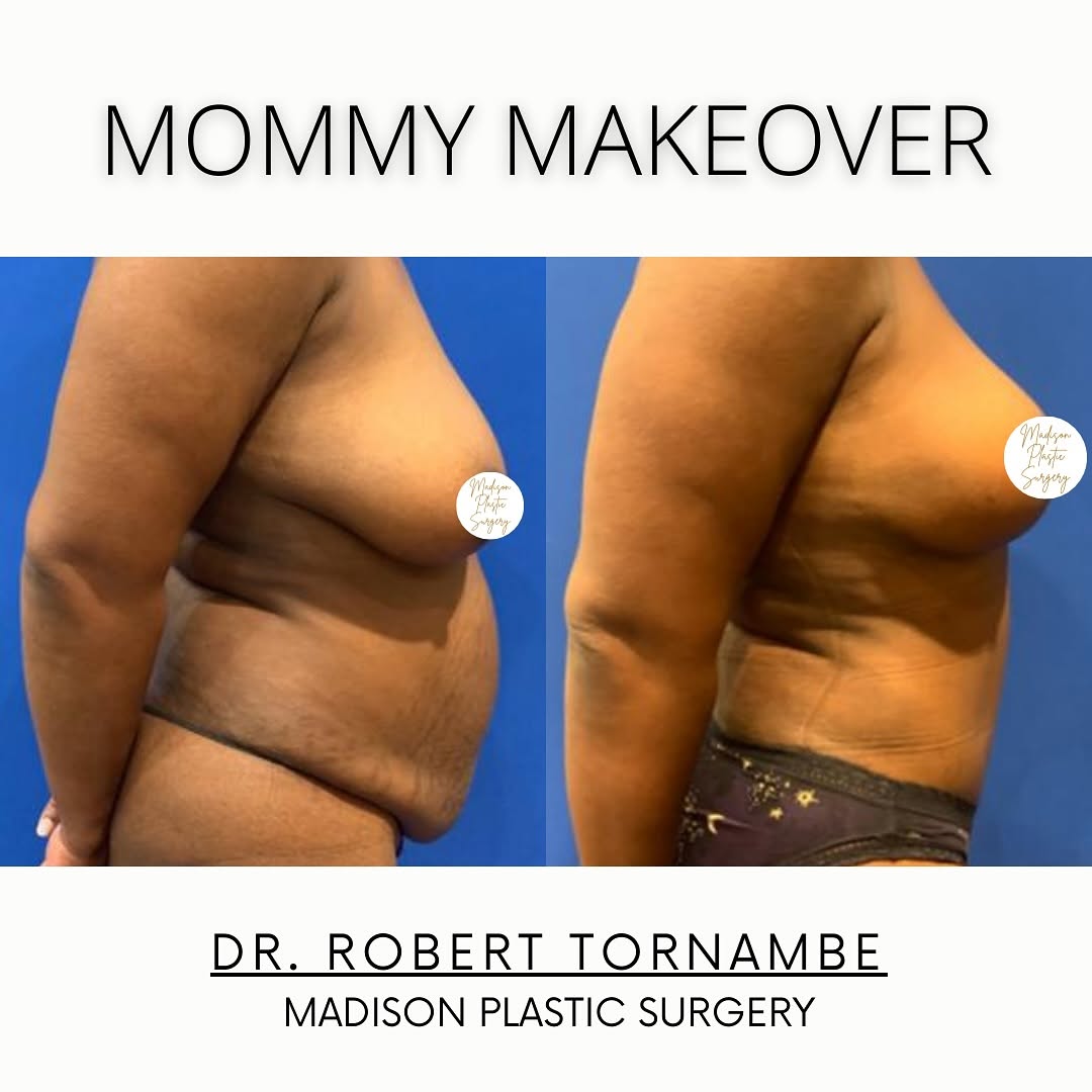 Instagram post by Dr. Robert M. Tornambe: A Mommy Makeover refers to a combination of cosmetic procedures that are designed to meet the aesthetic goals of women whose bodies have cha…