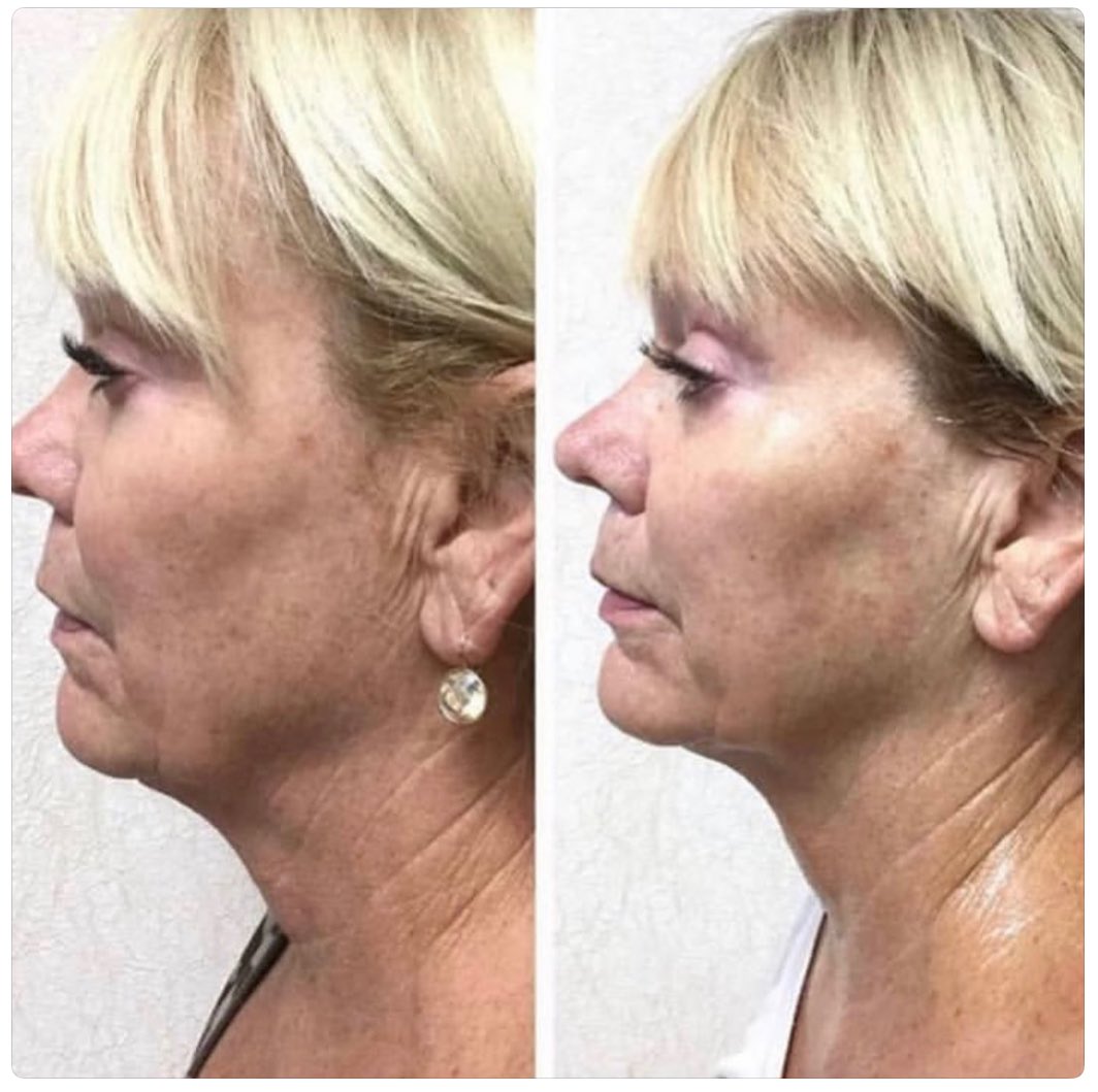 Instagram post by Dr. Robert M. Wald, Jr.: Mothers Day Specialโฆ 15% OFF our Lutronic Infini Microneedling Treatment๐๐ผ Specializes in skin tightening that uses radio frequency energyโฆ
