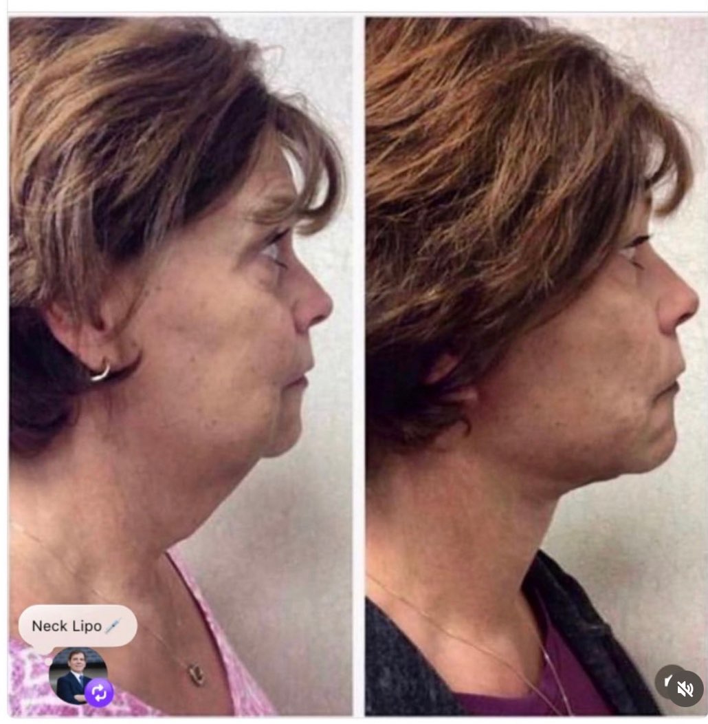 Instagram post by Dr. Robert M. Wald, Jr.: Neck Lipo๐๐ผ Call for our Summer Specialsโ๏ธ . . To schedule your consultation, please contact my office. โ๏ธ(714)738-4282 ๐Fullerton, CA . โฆ