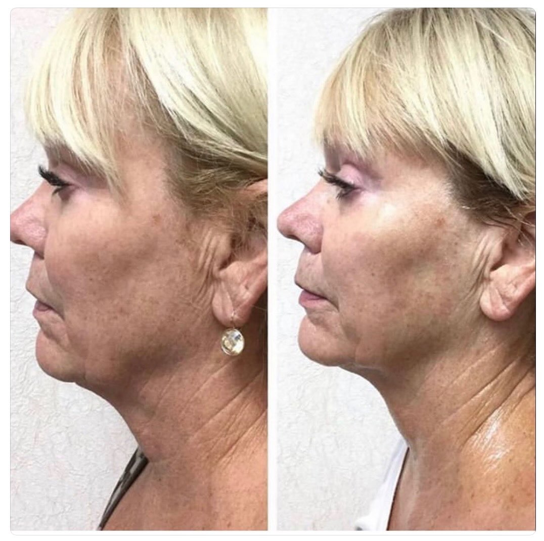 Instagram post by Dr. Robert M. Wald, Jr.: Happy Summer๐ Experience our Infini treatment that specializes in tightening of the skin, reducing fine lines, scars and improving tone & tโฆ