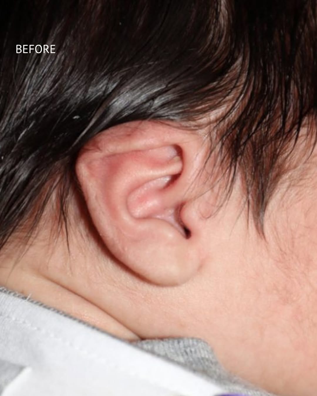 Instagram post by Dr. Robert Morin: A gentle, noninvasive correction: infant ear molding was performed on this 4-week-old baby with congenital external ear deformities involvin…