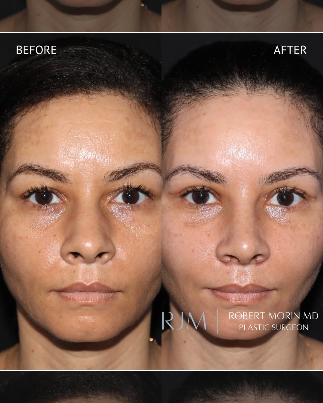 Instagram post by Dr. Robert Morin: Complex rhinoplasty requires careful structural planning to refine the nasal shape while maintaining stability, support, and airway function…