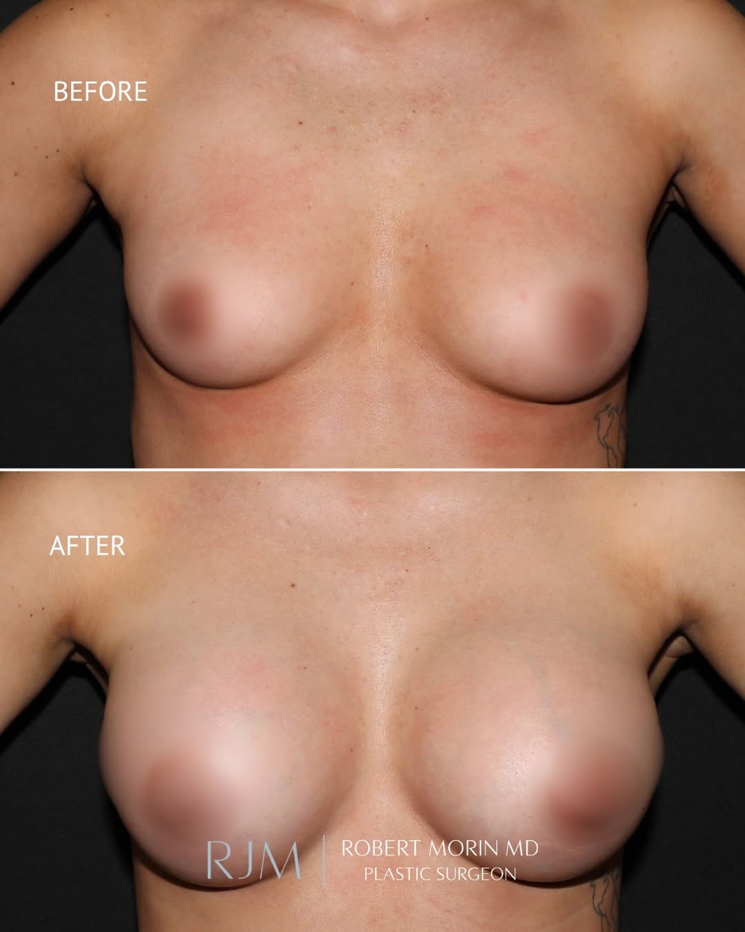 Instagram post by Dr. Robert Morin: A natural and proportionate result following breast augmentation for this 24-year-old patient. 325cc smooth round silicone implants were pla…