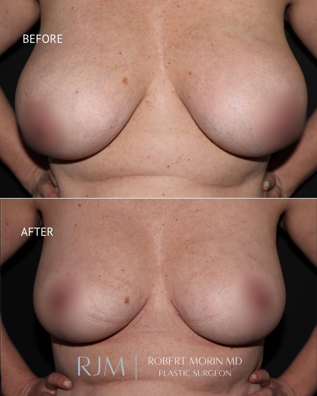 Instagram post by Dr. Robert Morin: This patient underwent breast reduction surgery to decrease breast volume and create a lighter, more proportionate breast contour. The proce…