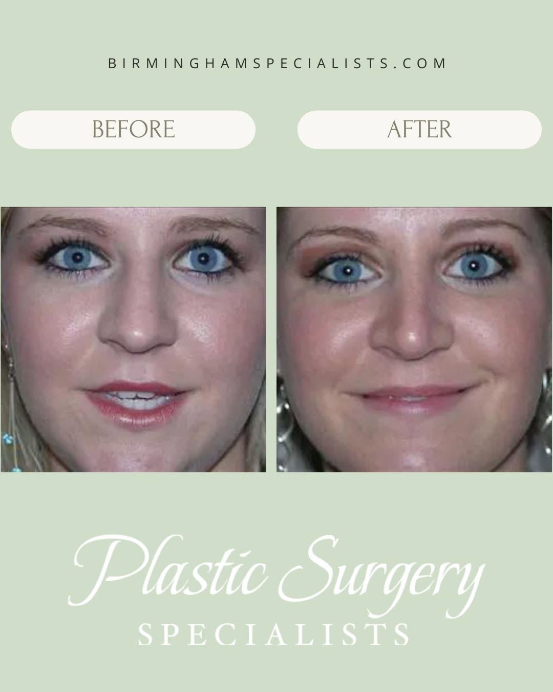 Instagram post by Dr. Robert Oliver Jr.: Subtle changes can make a beautiful difference. ✨ This rhinoplasty transformation refined the nasal profile while maintaining natural facial…