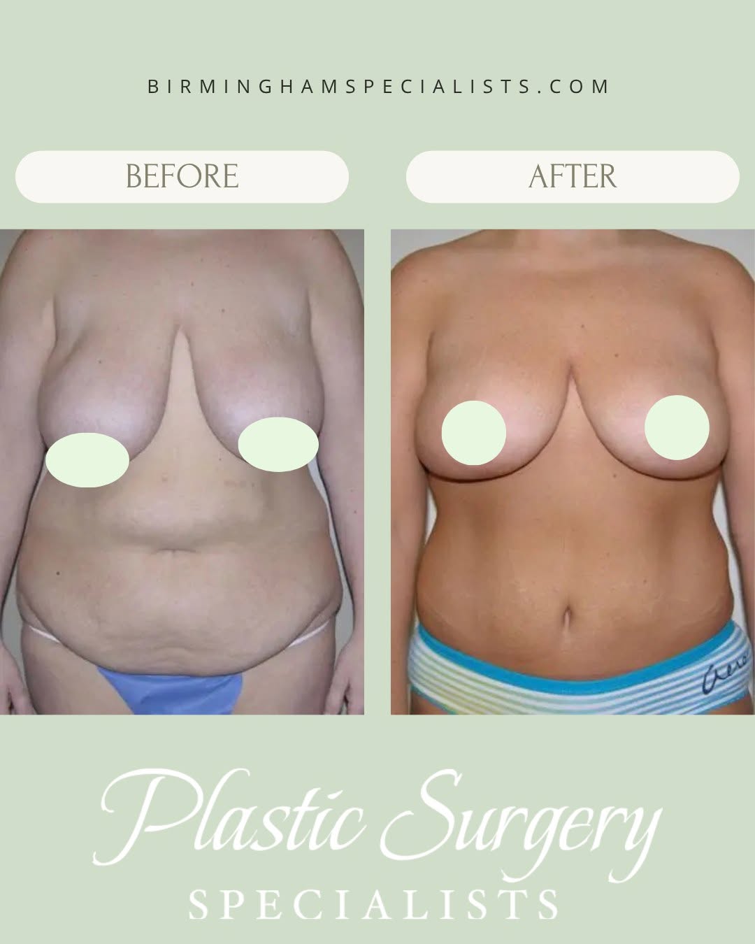 Instagram post by Dr. Robert Oliver Jr.: A more defined waistline and smoother abdominal contour ✨ This before-and-after showcases the transformation that can be achieved by combini…