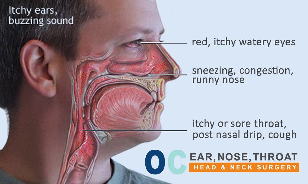 Instagram post by Dr. Robert Pettis: ALLERGIC RHINITIS⠀ ⠀ Allergies are very common. 35-40% of the people in this country complain of moderate to severe symptoms from Allergic R…