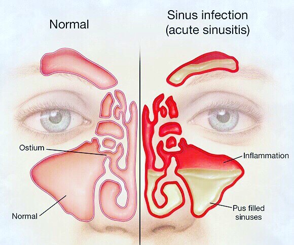Instagram post by Dr. Robert Pettis: With the recent changes in weather many are experiencing cold like symptoms.⠀ ⠀ How to tell if your symptoms are allergies, a cold or sinusi…