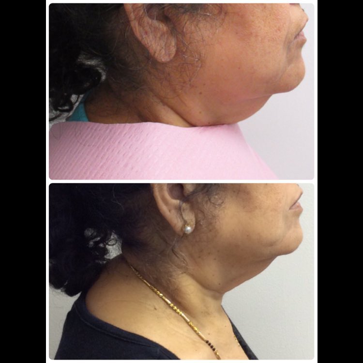 Instagram post by Dr. Robert S. Bader: Ultherapy Top:before Bottom: After. 4 month difference. - #derm#ultherapy#dermatology#dermatologist#bocaraton#southflorida#derma#ulthera#dee…