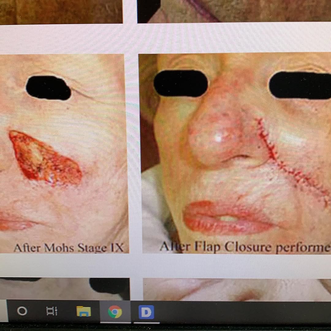 Instagram post by Dr. Robert S. Bader: Many people are not happy after Mohs’ Surgery. Why? Visit. www.drbader.com/skin-cancer-information/cancer-treatment/101-Mohs-micrographic-su…