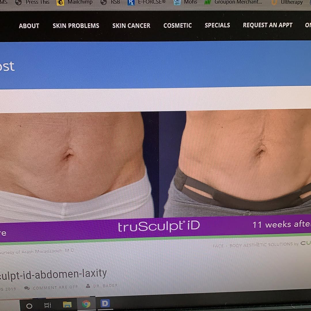 Instagram post by Dr. Robert S. Bader: Fat reduction and skin tightening in 15 minutes! Freezing can’t do that! #fatloss #trusculptid