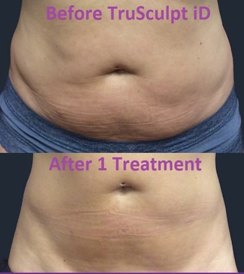 Instagram post by Dr. Robert S. Bader: Get your Skinny on! Melt fat and tighten skin in 15 minutes. Prices starting at $600 for our Summer event. www.drbader.com