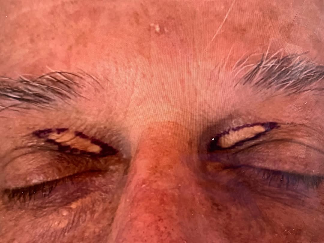 Instagram post by Dr. Robert S. Bader: SWIPE FOR RESULTS* #eyelidsurgery #Xanthelasma