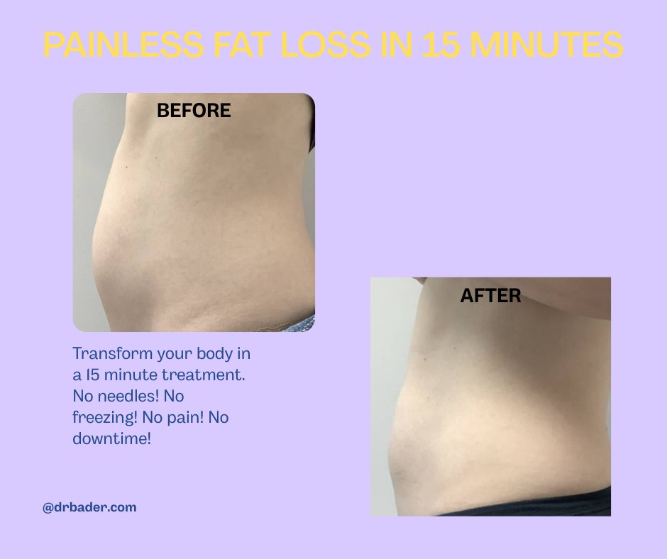Instagram post by Dr. Robert S. Bader: Get ready to look your best! Click here for more info: https://drbader.com/cosmetic-treatments/truscupt-id-non-surgical-fat-reduction/