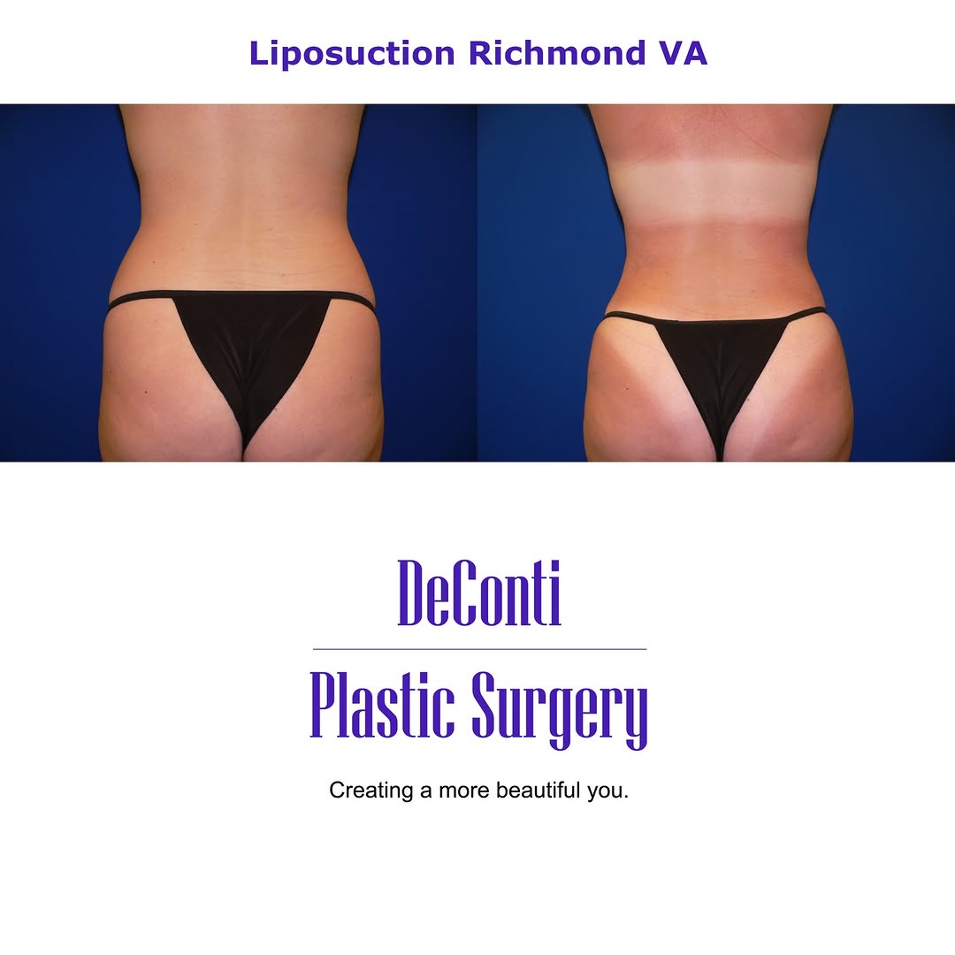 Instagram post by Dr. Robert W. DeConti: POV: Waist snatched! She went from rectangular to hourglass in 2 hours 🔥 This patient wanted one thing: a DRAMATIC waist reduction. She had…