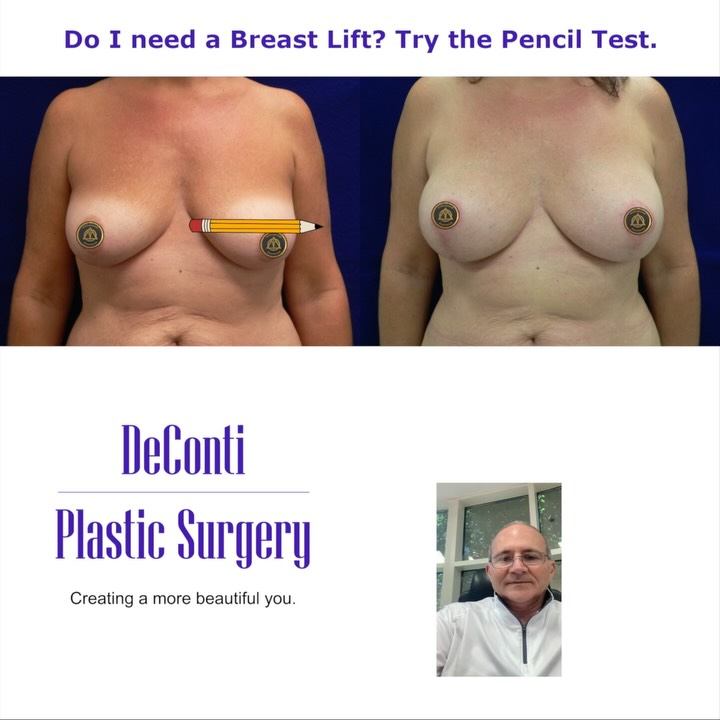 Instagram post by Dr. Robert W. DeConti: Do I need a breast lift? Ask yourself these 3 questions before your consultation. Save this and send to friends. A breast lift (mastopexy) f…